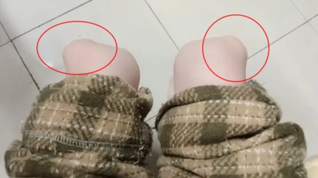 دختری که میتواند کشکک زانوی خود را به دلخواه جابهجا کند/ عکس