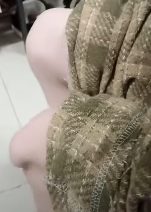 دختری که میتواند کشکک زانوی خود را به دلخواه جابهجا کند/ عکس