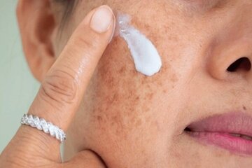 اگر پوست خشکی دارید علت آن کمبود این ویتامینها است اگر پوست خشکی دارید علت آن کمبود این ویتامینها است