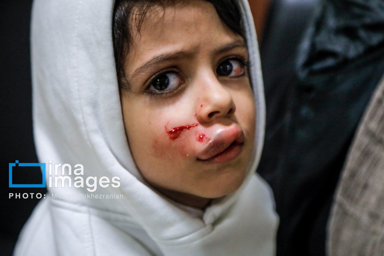 تصاویر دلخراش از کودکان آسیبدیده چهارشنبهسوری