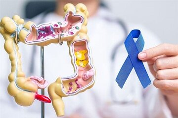 این افراد در معرض خطر سرطان روده هستند این افراد در معرض خطر سرطان روده هستند