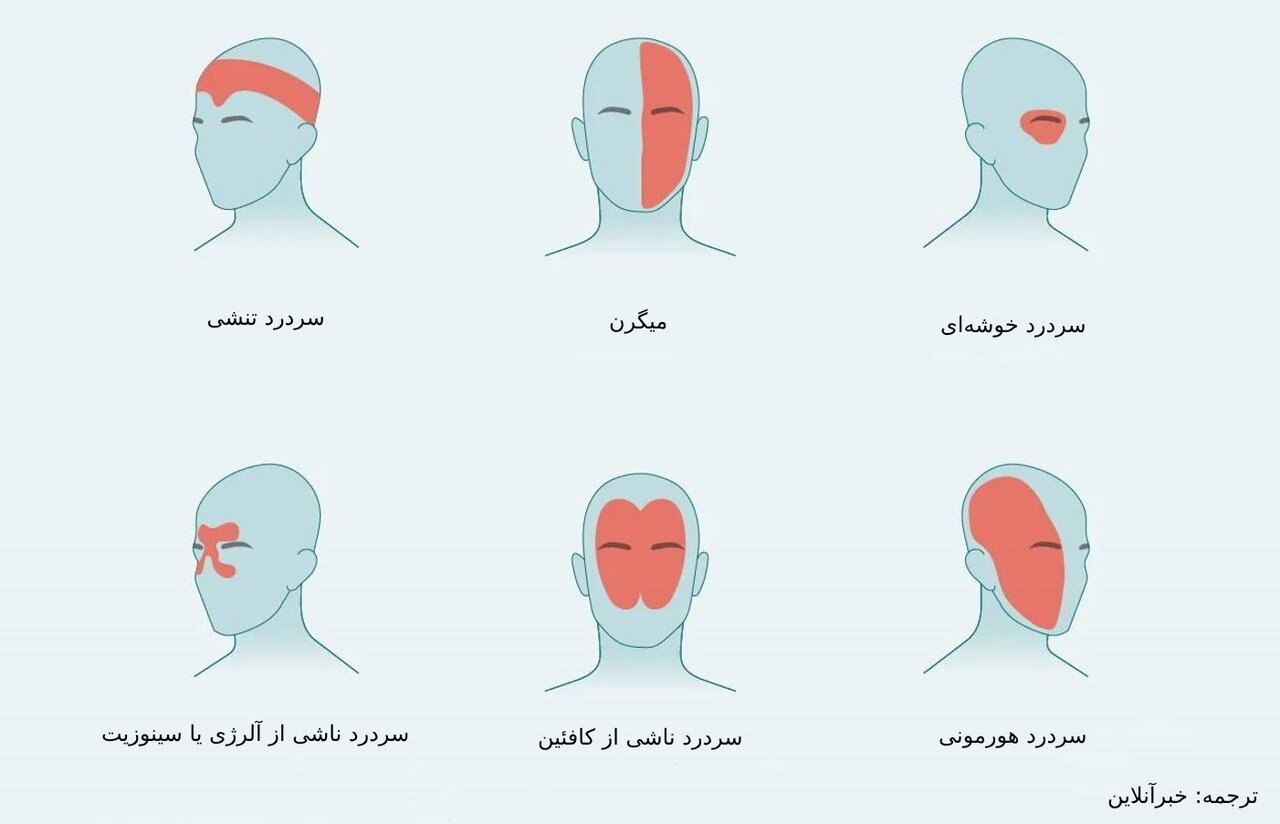 درد در نواحی مختلف سر ناشی از چیست؟/ از سردرد خوشهای تا سردرد رعد و برقی+ تصاویر