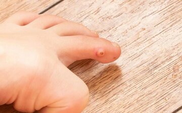 میخچه چگونه درمان میشود؟ میخچه چگونه درمان میشود؟