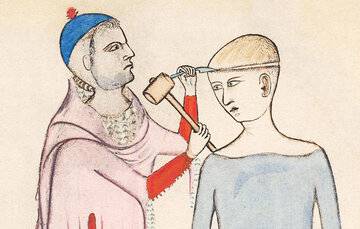 سیر تکامل جراحی مغز؛ از سنگ و مته تا رباتهای ناجی/ اولین جراحی موفق مغز به چه زمانی برمیگردد؟/ سوراخکردن مغز به قصد خروج ارواح خبیث! سیر تکامل جراحی مغز؛ از سنگ و مته تا رباتهای ناجی/ اولین جراحی موفق مغز به چه زمانی برمیگردد؟/ سوراخکردن مغز به قصد خروج ارواح خبیث!