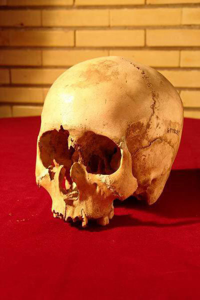 سیر تکامل جراحی مغز؛ از سنگ و مته تا رباتهای ناجی/ اولین جراحی موفق مغز به چه زمانی برمیگردد؟/ سوراخکردن مغز به قصد خروج ارواح خبیث!