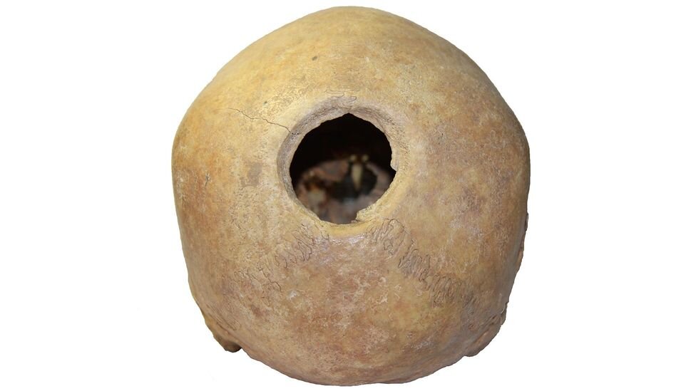 سیر تکامل جراحی مغز؛ از سنگ و مته تا رباتهای ناجی/ اولین جراحی موفق مغز به چه زمانی برمیگردد؟/ سوراخکردن مغز به قصد خروج ارواح خبیث!