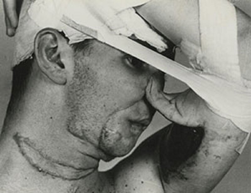 تاریخچه عملهای زیبایی/ استفاده از پوست پیشانی برای ترمیم بینیهای قطعشده در مجازاتها/ اولین جراحی زیبایی تاریخ کِی انجام شد؟