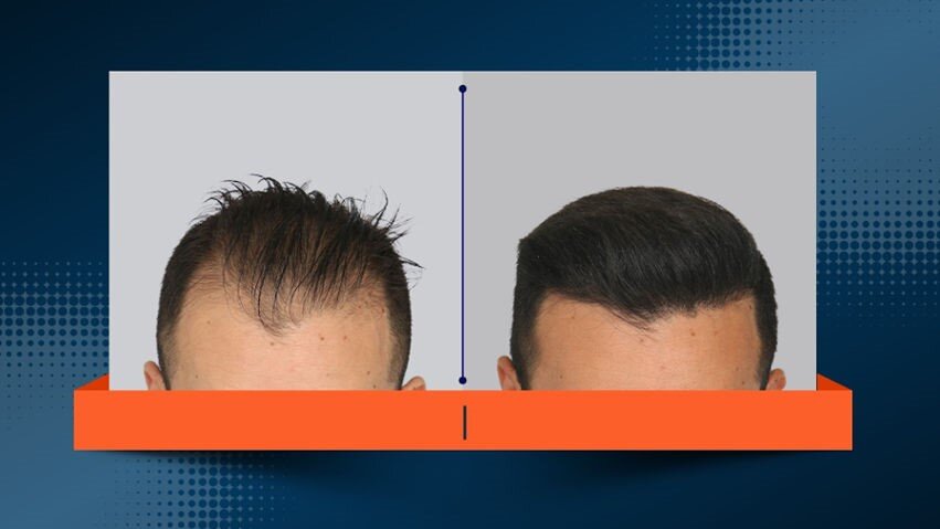 بدون کچلکردن و تراشیدن سر کاشت کنید