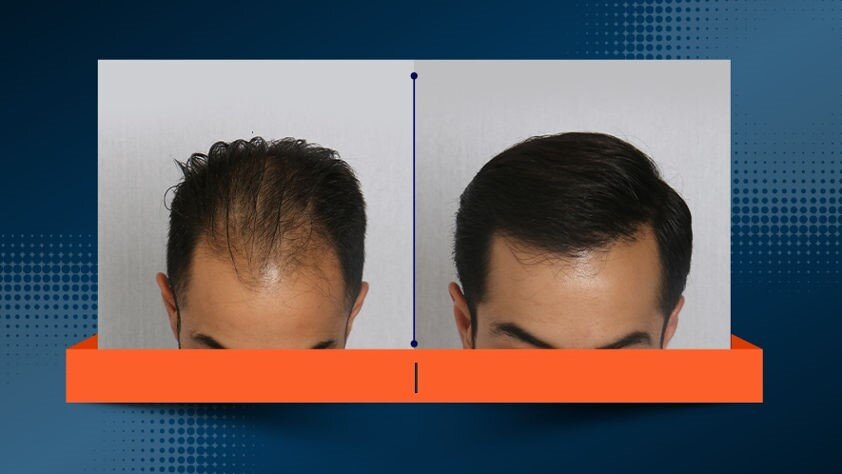 بدون کچلکردن و تراشیدن سر کاشت کنید