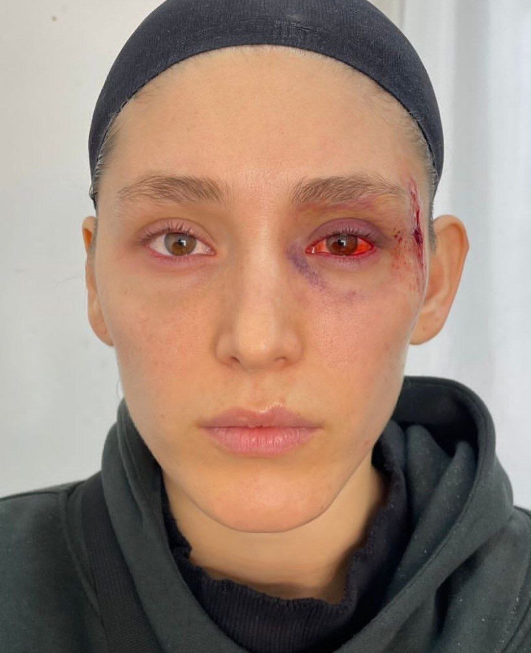 عکس | صورت کبود فرشته حسینی با چشم خونریزی کرده!