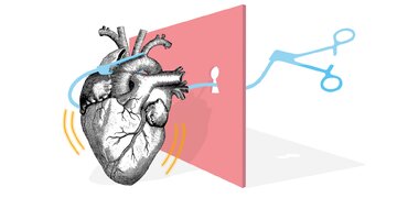 سیر تکامل جراحی قلب/ نخستین دریافتکننده پیوند قلب چند روز زنده ماند؟ سیر تکامل جراحی قلب/ نخستین دریافتکننده پیوند قلب چند روز زنده ماند؟