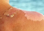 برای برنزه کردن مراقب خطر سرطان باشید/ جزئیات