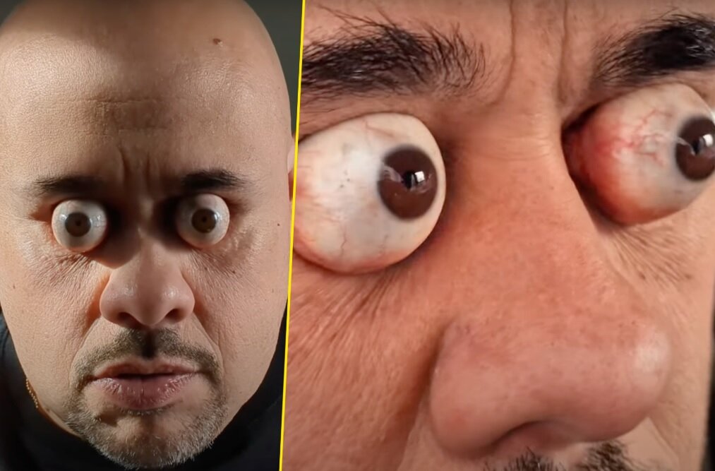 مردی که با چشمان از حدقه بیرونزده رکوردهای گینس را جابهجا کرد/ عکس