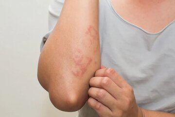 بیماری «سلیاک» چیست و چه علائمی دارد؟