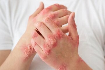 بیماری پسوریازیس چیست؟ بیماری پسوریازیس چیست؟