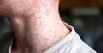 شیوع یک بیماری در ۹ ایالت آمریکا خبرساز شد شیوع یک بیماری در ۹ ایالت آمریکا خبرساز شد