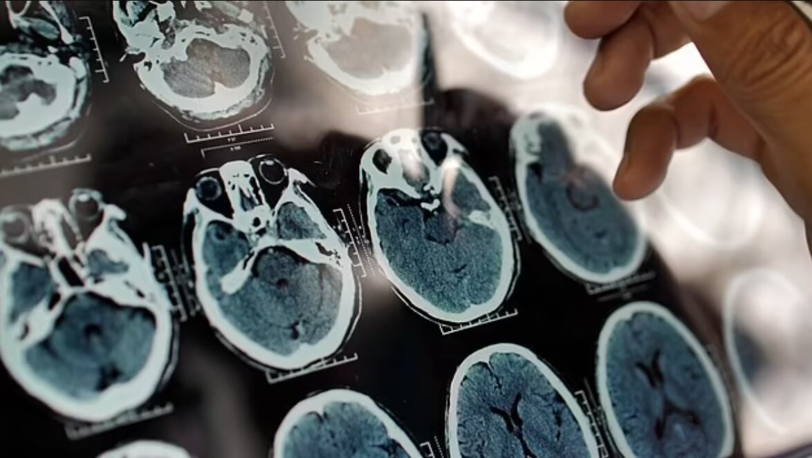 کشف کلید مولکولی مرتبط با بیماری آلزایمر / مسیر نوینی برای حفظ حافظه مشخص شد کشف کلید مولکولی مرتبط با بیماری آلزایمر / مسیر نوینی برای حفظ حافظه مشخص شد