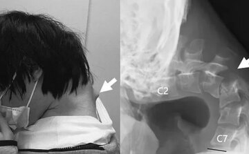 ابتلای مرد ۲۵ ساله به سندرم سر افتاده بر اثر استفاده بیش از حد از تلفن همراه/ عکس ابتلای مرد ۲۵ ساله به سندرم سر افتاده بر اثر استفاده بیش از حد از تلفن همراه/ عکس
