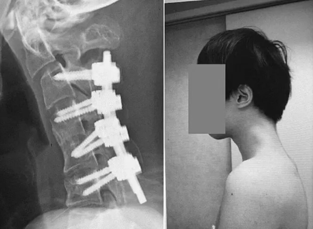 بیماری سندرم سر افتاده چه علائمی دارد؟/ عکس