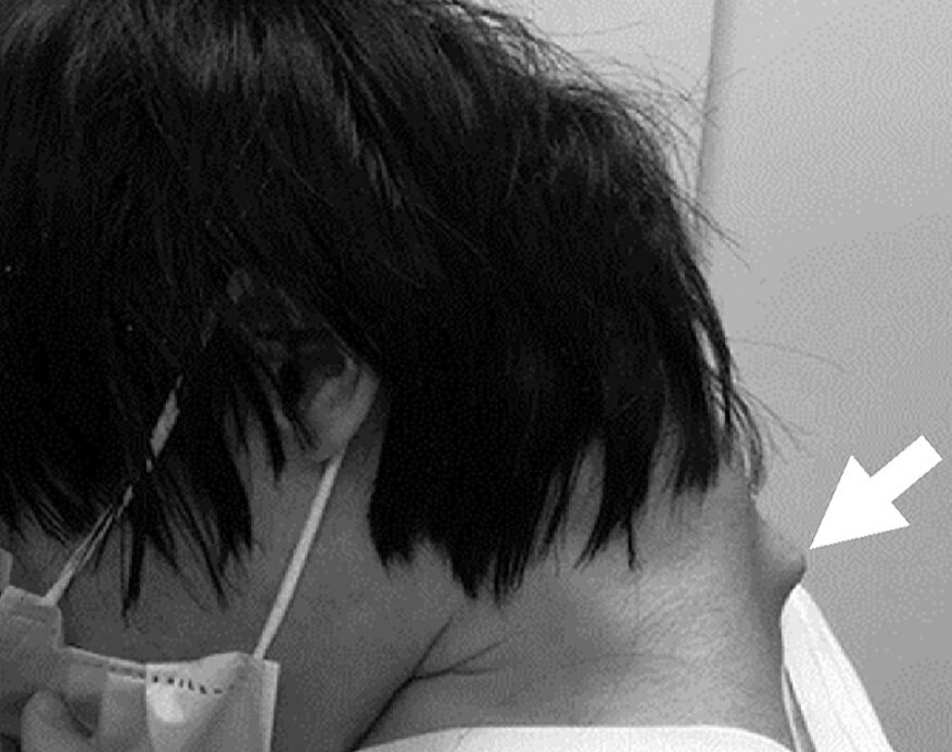 بیماری سندرم سر افتاده چه علائمی دارد؟/ عکس