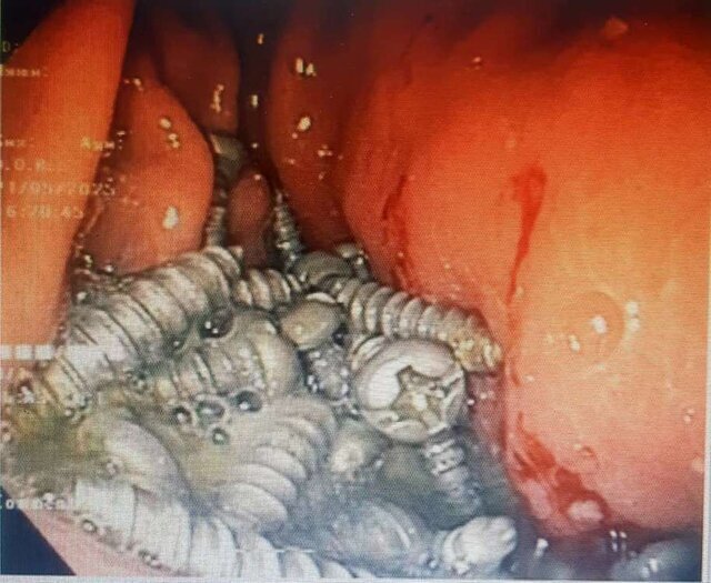 خارج کردن ۴۷ پیچ تیز از معده یک بیمار در کرج/ عکس
