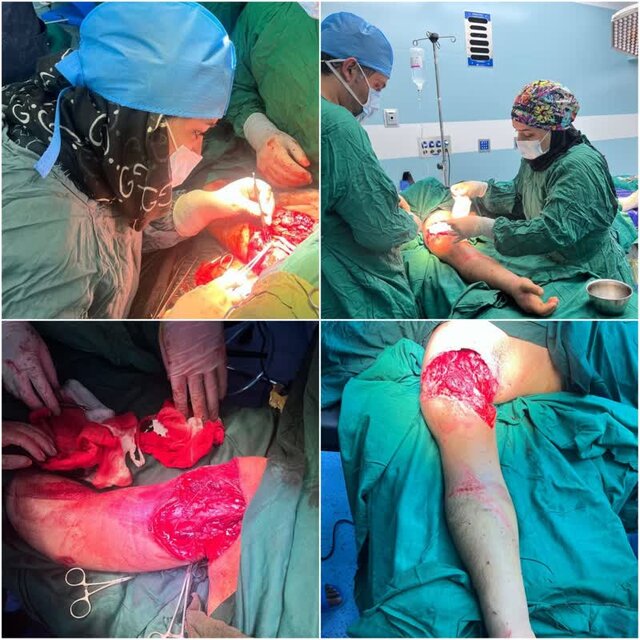 پیوند دست قطع شده یک نوجوان در اردبیل