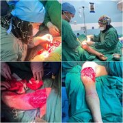 پیوند دست قطع‌ شده یک نوجوان در اردبیل