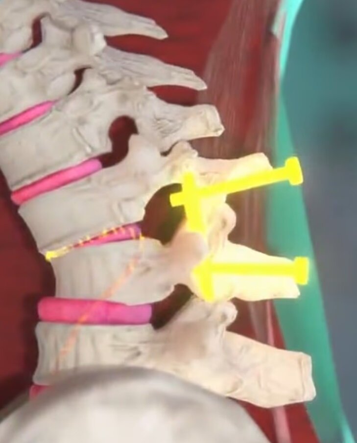 عطسه شدید این زن را دو سال فلج کرد/ عکس عطسه شدید این زن را دو سال فلج کرد/ عکس