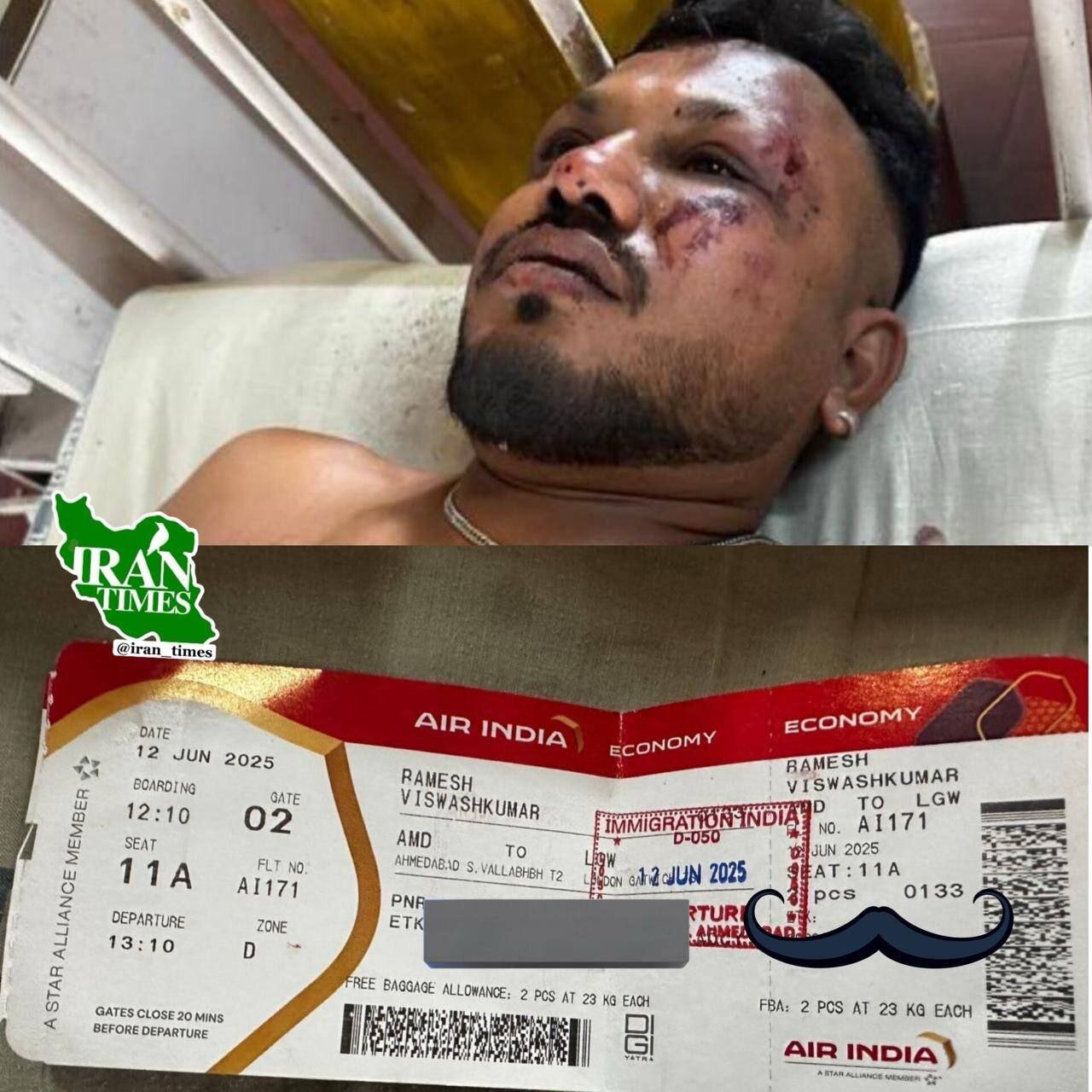 تنها بازمانده سقوط هواپیما در هند/ عکس