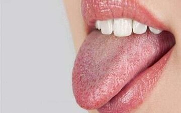 زبان سفید چه چیزی درباره سلامت میگوید؟ زبان سفید چه چیزی درباره سلامت میگوید؟