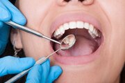 تأثیر استرس بر سلامت دهان و دندان