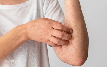 در مواجهه با اشعه فرابنفش چه کنیم؟