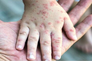 سر و کله ویروس سرخک از کجا پیدا شد؟ سر و کله ویروس سرخک از کجا پیدا شد؟