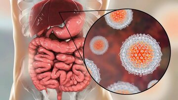 آمار مبتلایان به هپاتیت در ایران اعلام شد آمار مبتلایان به هپاتیت در ایران اعلام شد
