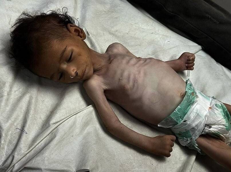 داستان تلخ پزشکان گرسنه در غزه/ کودکانی که تبدیل به اسکلت شدهاند/عکس