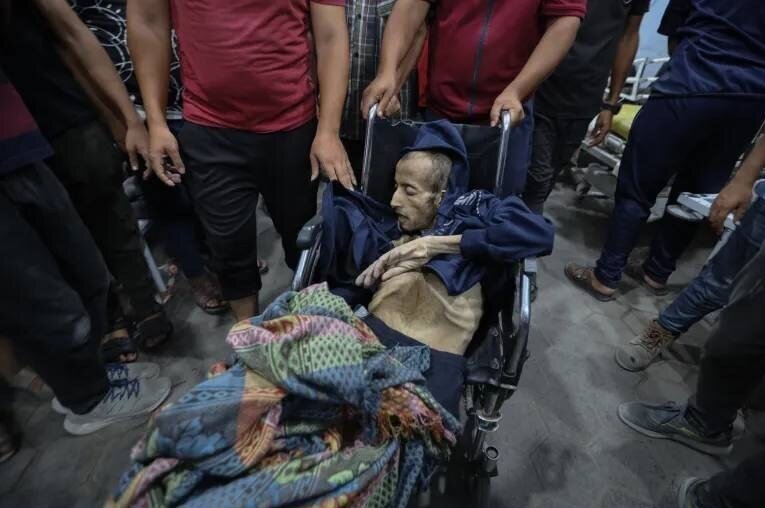 داستان تلخ پزشکان گرسنه در غزه/ کودکانی که تبدیل به اسکلت شدهاند/عکس