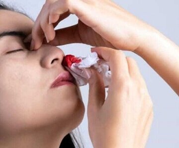 ارائه خدمات درمانی به ۹۷بیمار هموفیلی در قزوین