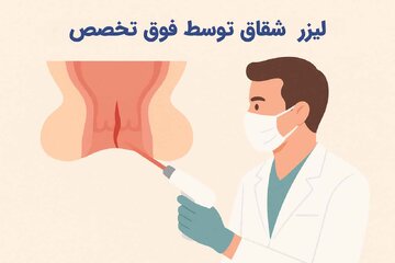 همه چیز در مورد لیزر شقاق