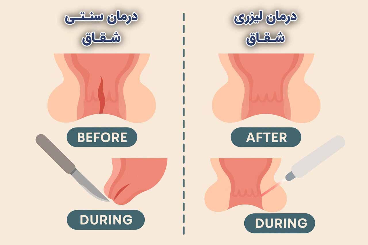همه چیز در مورد لیزر شقاق
