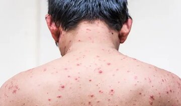 علائم آبلهمرغان در بزرگسالان علائم آبلهمرغان در بزرگسالان