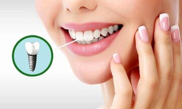 قیمت‌های ایمپلنت در تهران برای نیمه دوم سال ۱۴۰۴