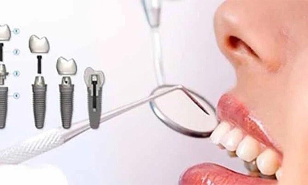 قیمتهای ایمپلنت در تهران برای نیمه دوم سال ۱۴۰۴