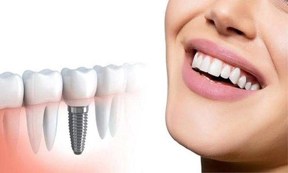 قیمتهای ایمپلنت در تهران برای نیمه دوم سال ۱۴۰۴