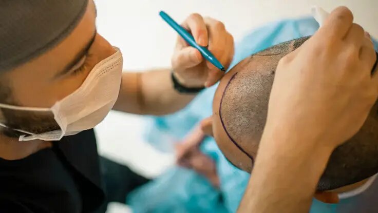 آموزش حرفه ای کاشت مو؛ بدون نیاز به مدرک دانشگاهی!
