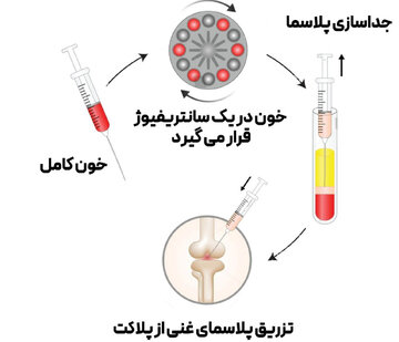 امید تازه برای درمان زانودرد و کمردرد مزمن با تزریق PRP