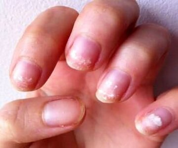 روش تشخیص کم‌خونی از روی پوست دست