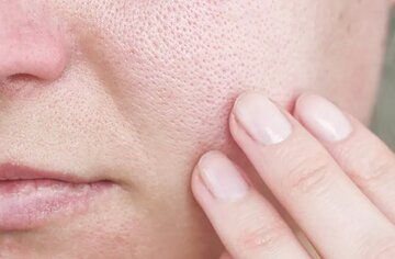 با منافذ باز پوست چه کنیم؟/ این منافذ به طور قطعی درمان میشوند؟ با منافذ باز پوست چه کنیم؟/ این منافذ به طور قطعی درمان میشوند؟