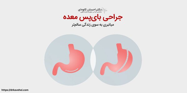 عمل بای پس معده