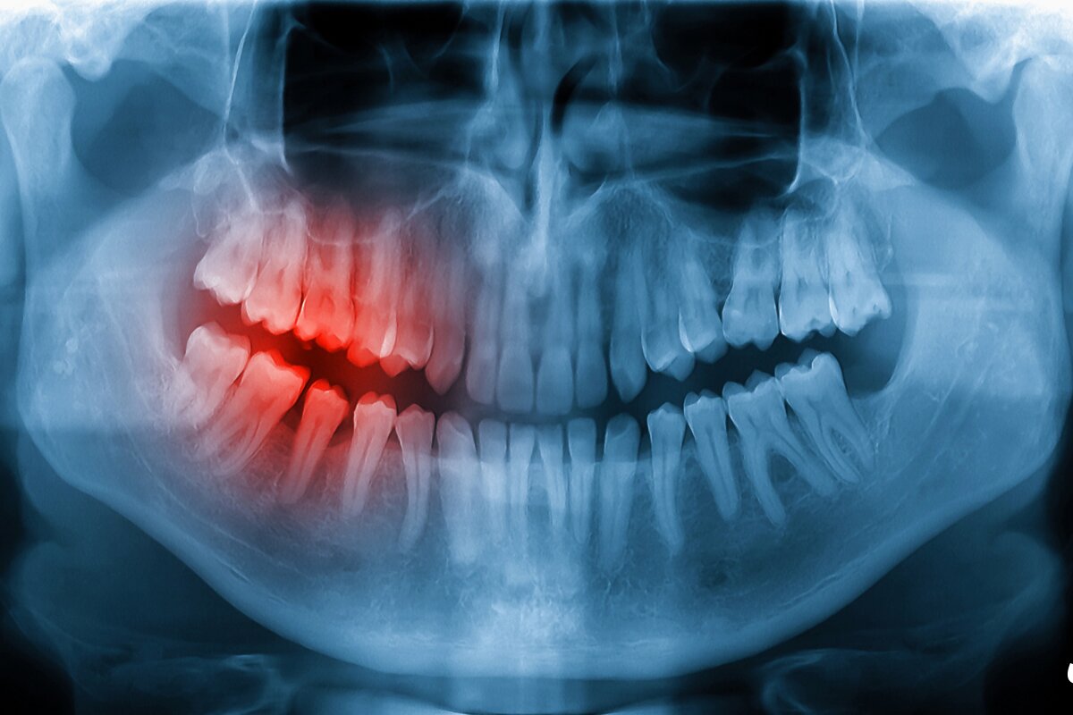 ایمپلنت دندان در غرب تهران