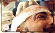 روش های روز دنیا در کاشت مو؛ واقعیت‌ها و آنچه باید قبل از عمل بدانید!
